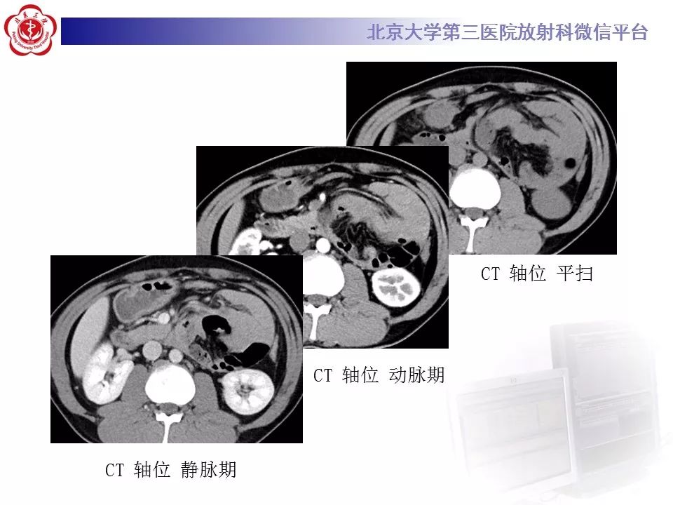 【病例】十二指肠旁疝1例CT影像表现