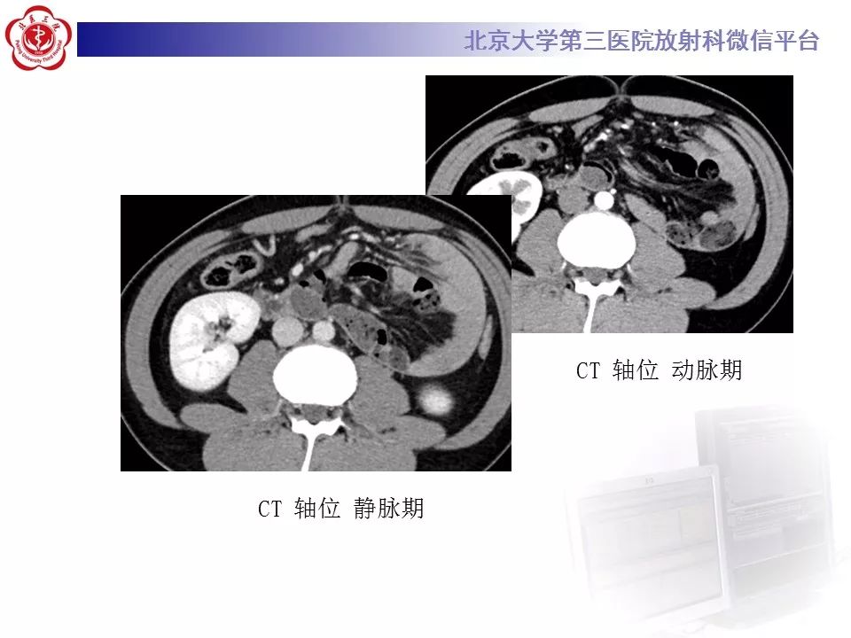 【病例】十二指肠旁疝1例CT影像表现