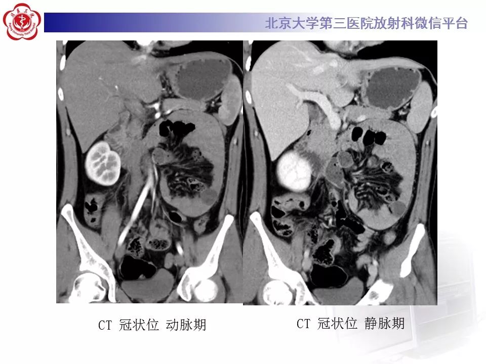 【病例】十二指肠旁疝1例CT影像表现