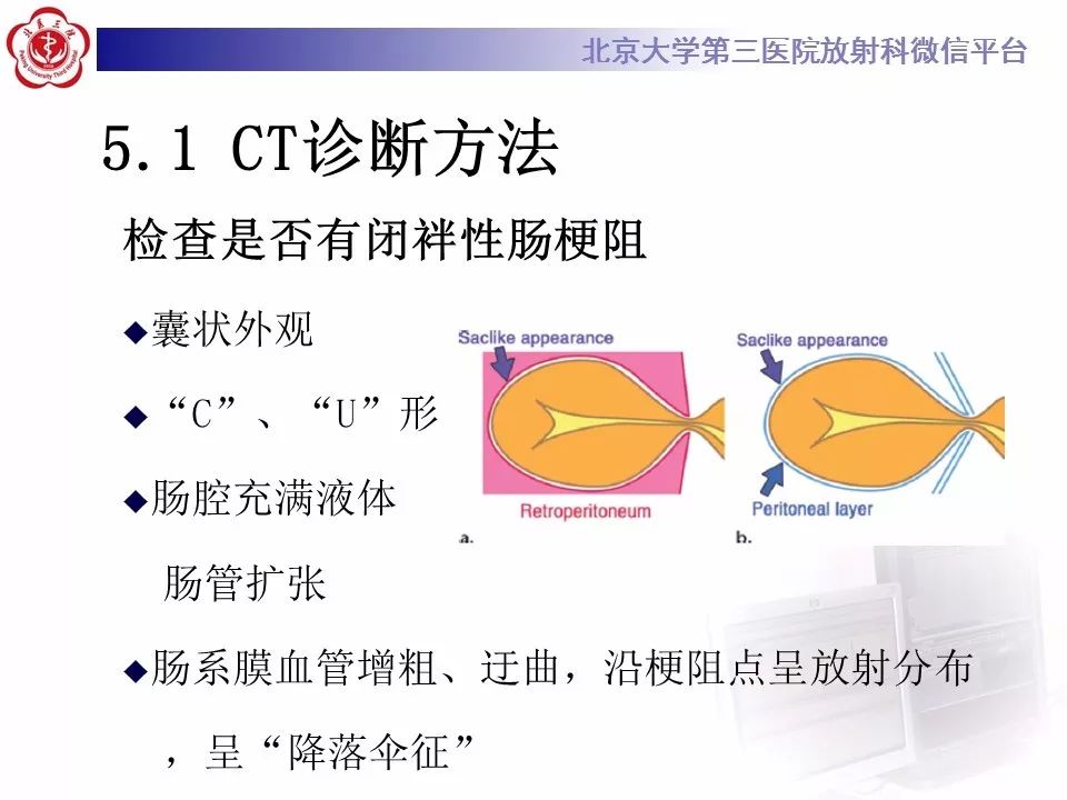 【病例】十二指肠旁疝1例CT影像表现