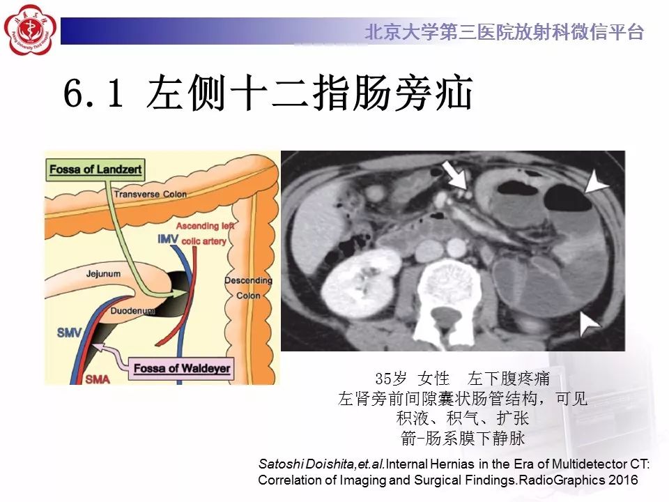 【病例】十二指肠旁疝1例CT影像表现