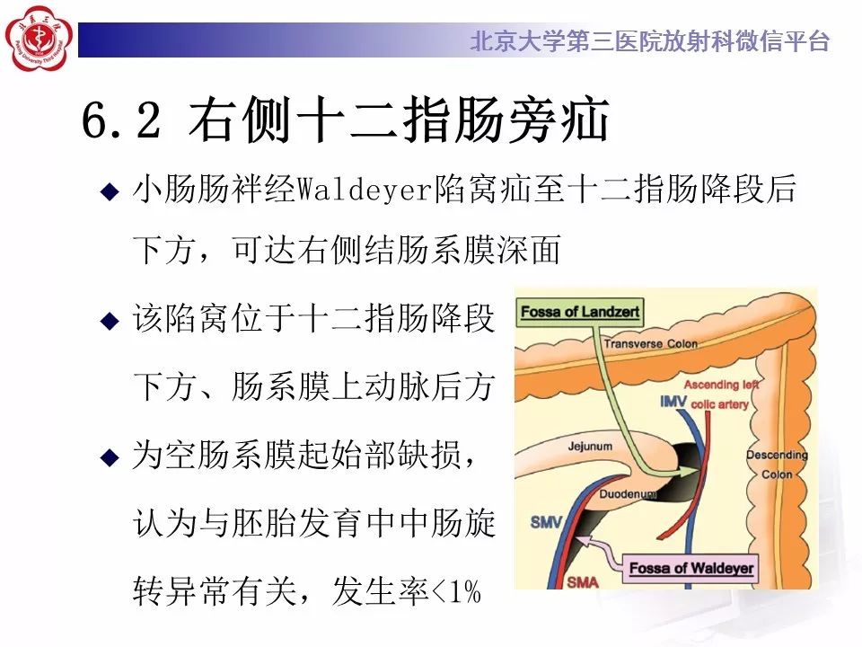【病例】十二指肠旁疝1例CT影像表现