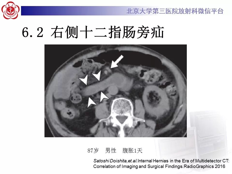 【病例】十二指肠旁疝1例CT影像表现