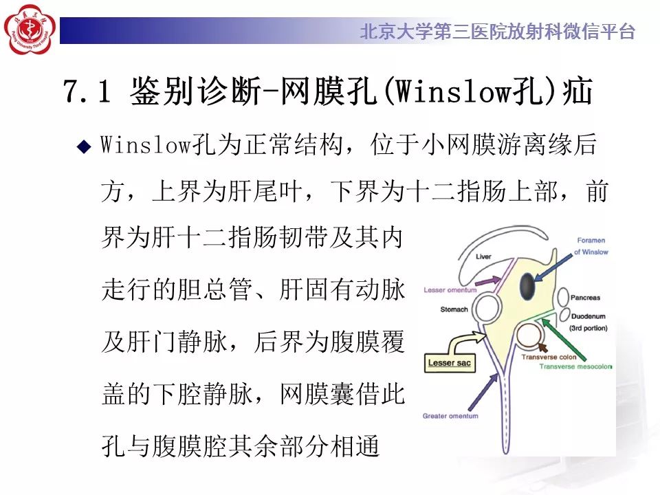 【病例】十二指肠旁疝1例CT影像表现