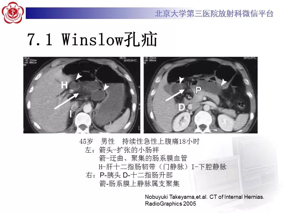 【病例】十二指肠旁疝1例CT影像表现