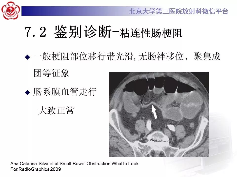 【病例】十二指肠旁疝1例CT影像表现