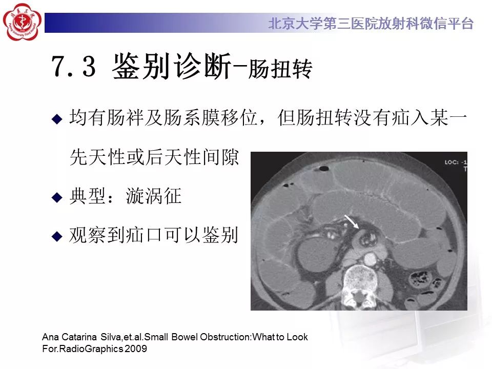 【病例】十二指肠旁疝1例CT影像表现
