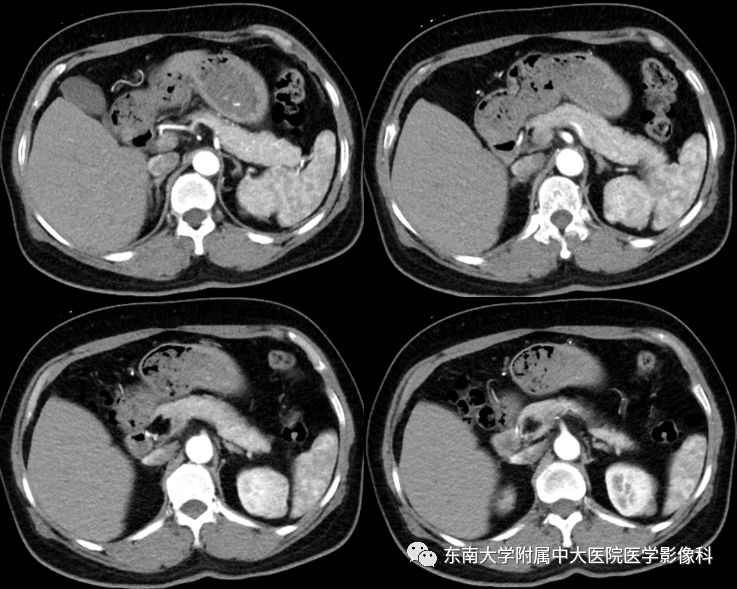 【病例】肾脏病例随访读片CT 【病例】肾脏病例随访读片CT