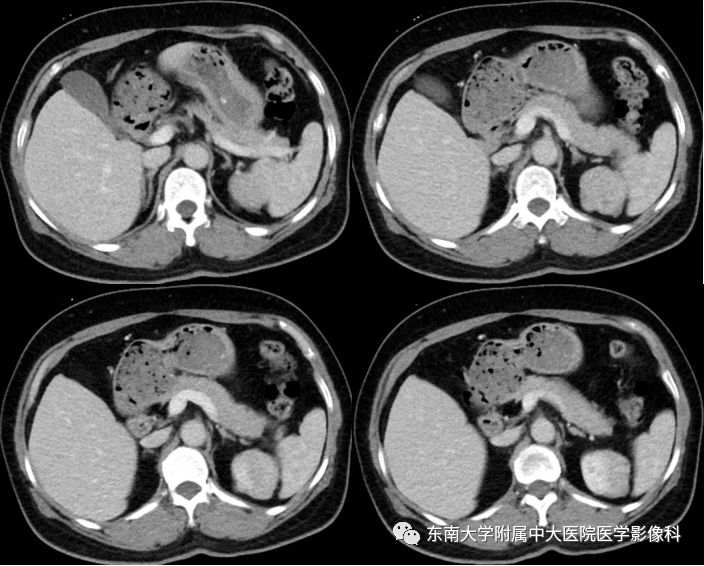 【病例】肾脏病例随访读片CT 【病例】肾脏病例随访读片CT