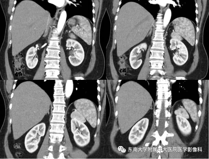 【病例】肾脏病例随访读片CT 【病例】肾脏病例随访读片CT