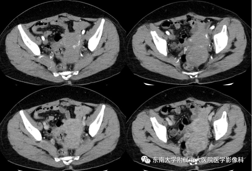 【病例】肾脏病例随访读片CT 【病例】肾脏病例随访读片CT