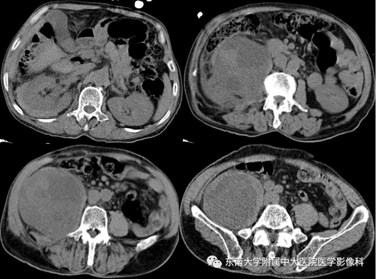 【病例】肾脏病例随访读片CT 【病例】肾脏病例随访读片CT