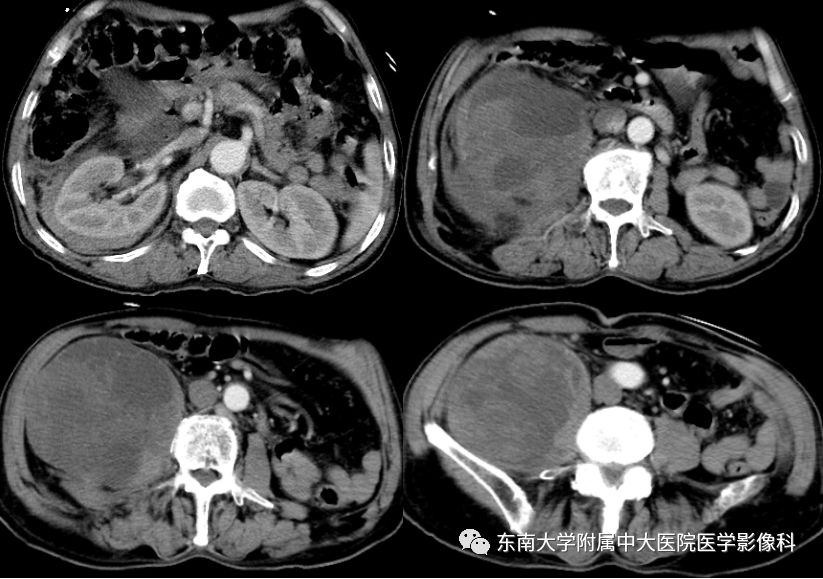 【病例】肾脏病例随访读片CT 【病例】肾脏病例随访读片CT