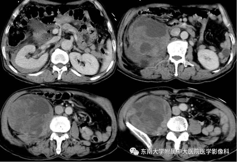 【病例】肾脏病例随访读片CT 【病例】肾脏病例随访读片CT