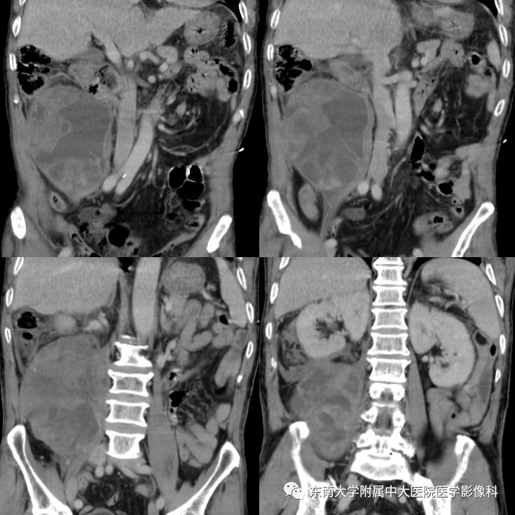 【病例】肾脏病例随访读片CT 【病例】肾脏病例随访读片CT