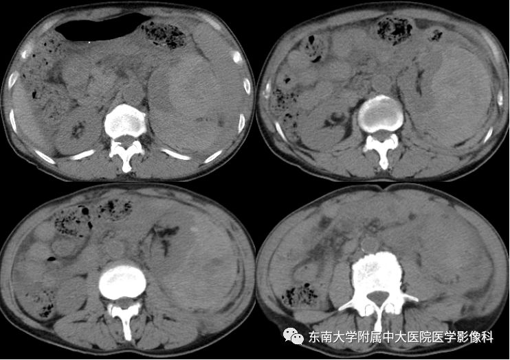 【病例】肾脏病例随访读片CT 【病例】肾脏病例随访读片CT