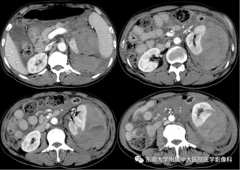 【病例】肾脏病例随访读片CT 【病例】肾脏病例随访读片CT