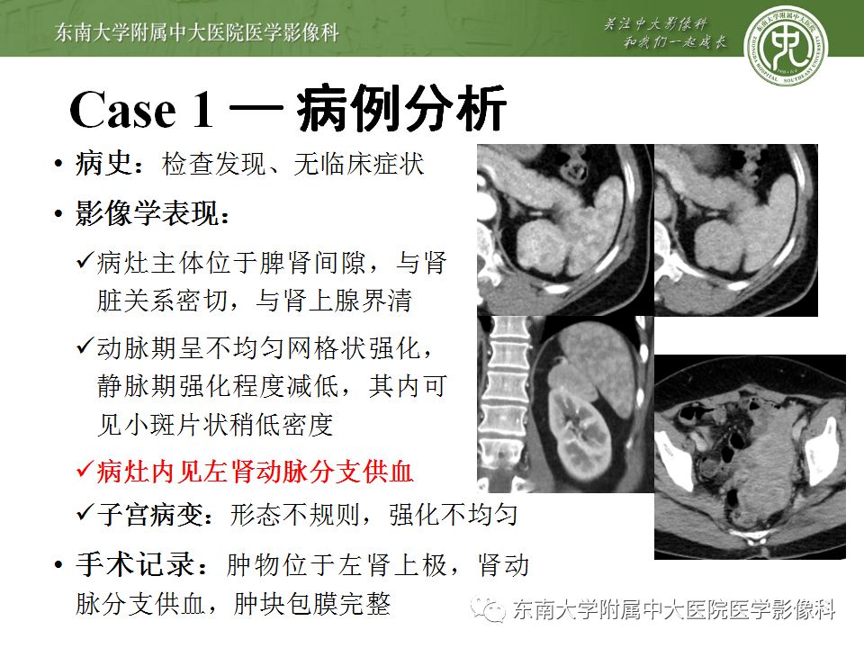 【病例】肾脏病例随访读片CT 【病例】肾脏病例随访读片CT