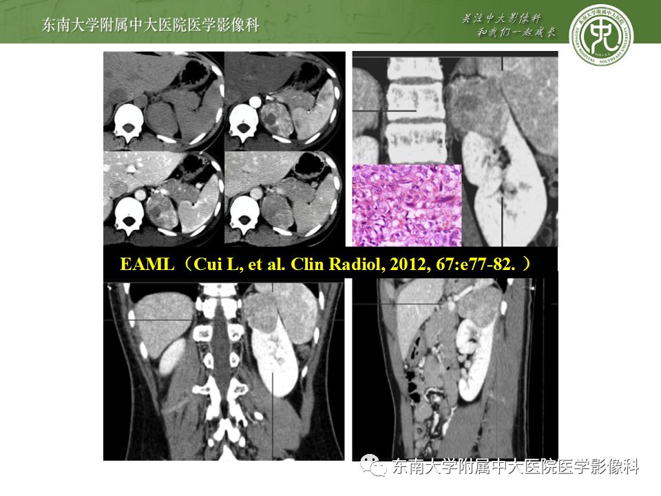 【病例】肾脏病例随访读片CT 【病例】肾脏病例随访读片CT
