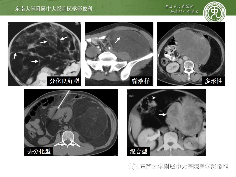 【病例】肾脏病例随访读片CT 【病例】肾脏病例随访读片CT