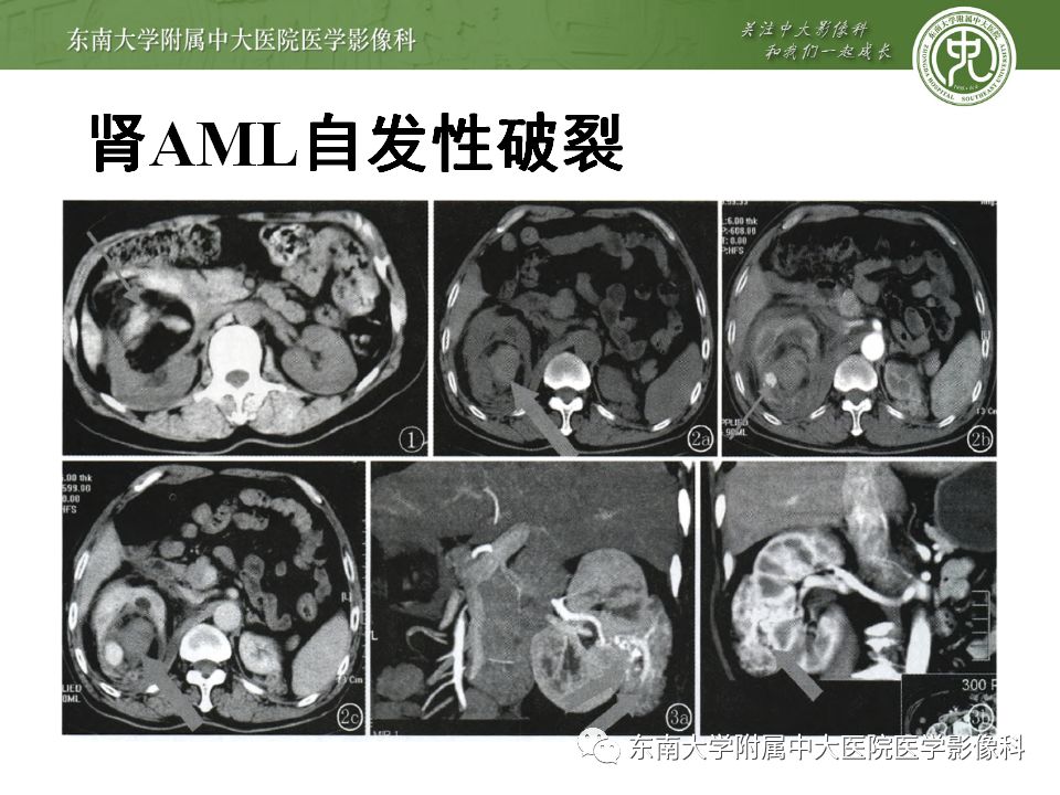 【病例】肾脏病例随访读片CT 【病例】肾脏病例随访读片CT