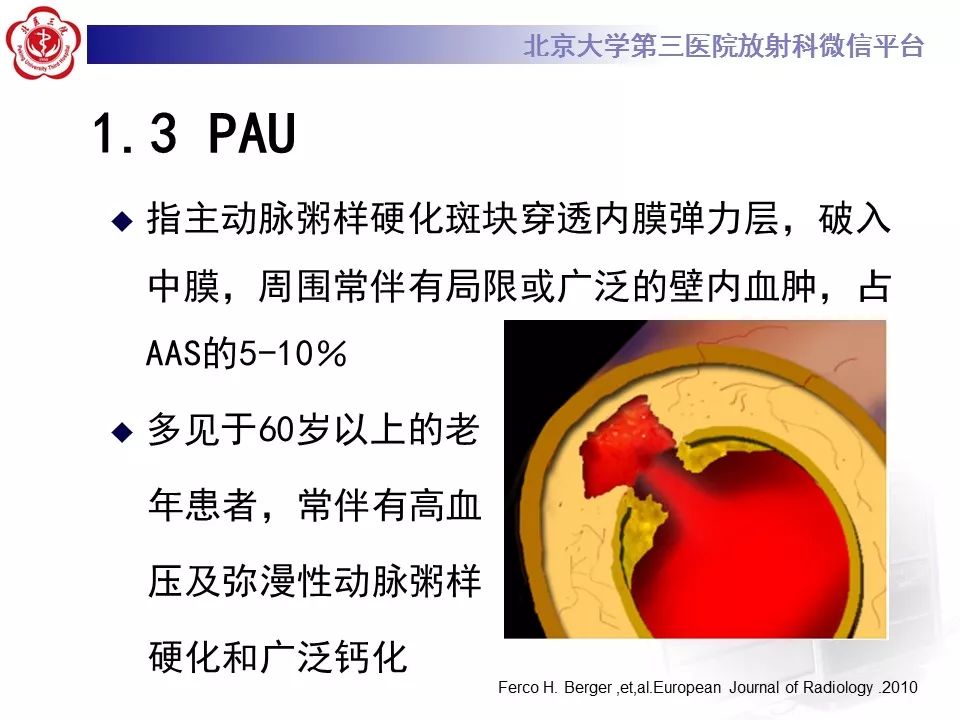 【PPT】急性动脉综合征
