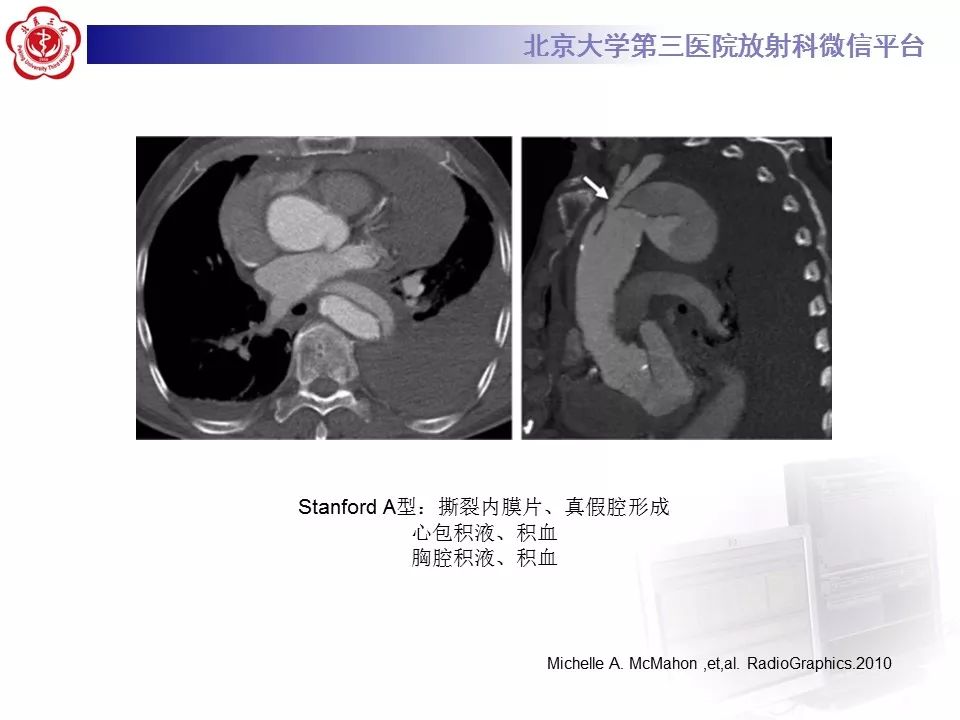 【PPT】急性动脉综合征