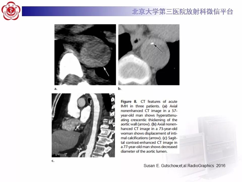 【PPT】急性动脉综合征