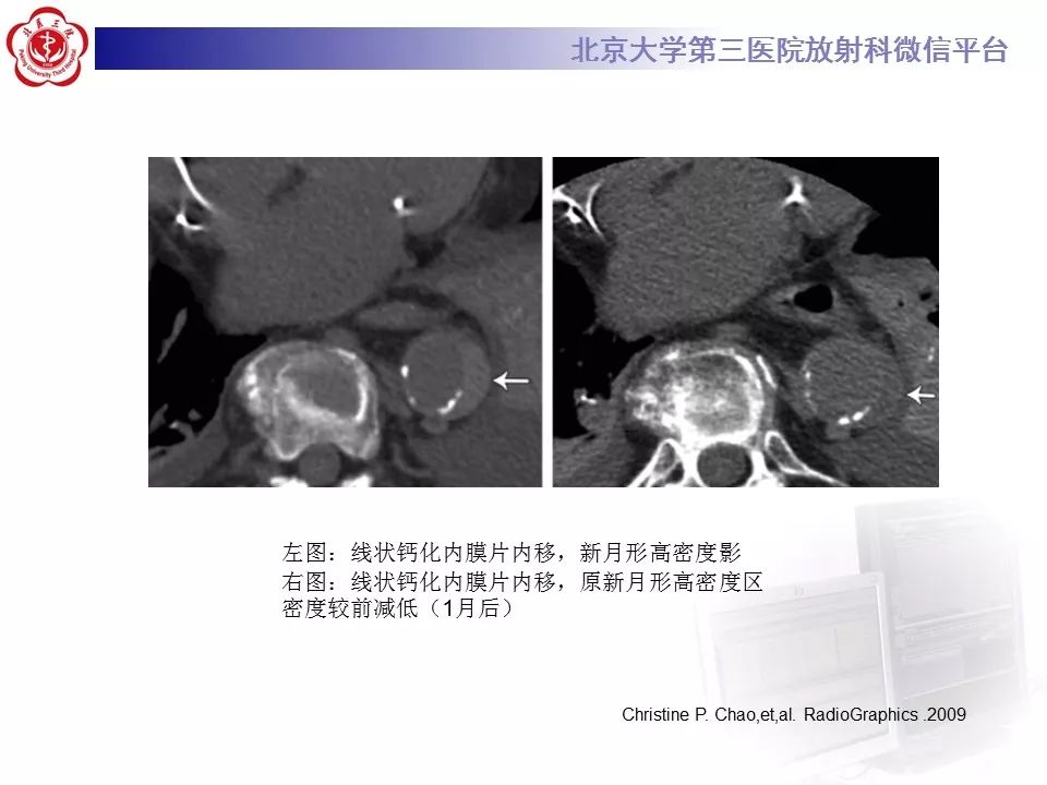 【PPT】急性动脉综合征