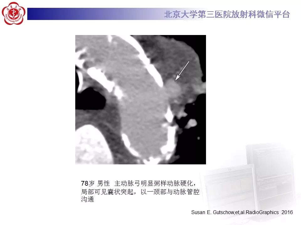 【PPT】急性动脉综合征