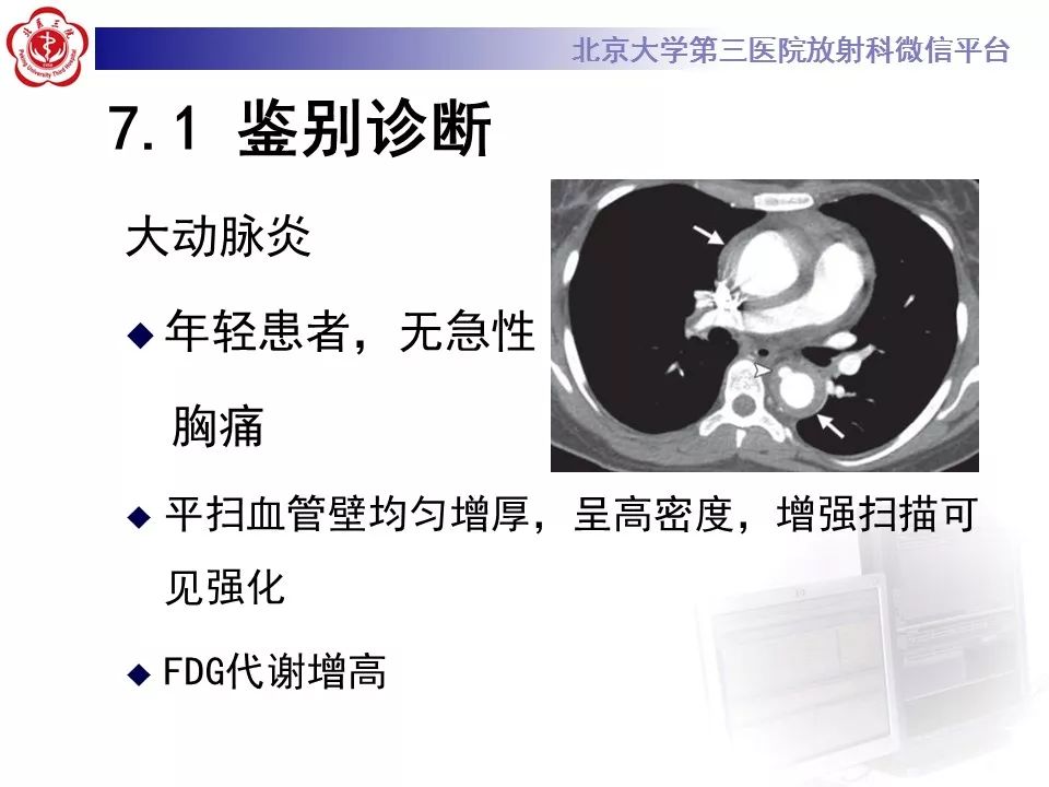 【PPT】急性动脉综合征