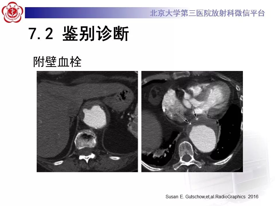 【PPT】急性动脉综合征