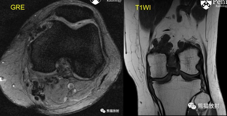 【双语病例】色素沉着绒毛结节性滑膜炎PVNS一例X线MR 【双语病例】色素沉着绒毛结节性滑膜炎PVNS一例X线MR