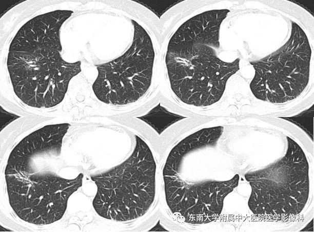【病例】肺亚实性结节—腺癌两例CT影像表现