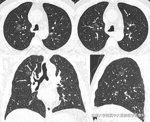 【病例】肺亚实性结节—腺癌两例CT影像表现