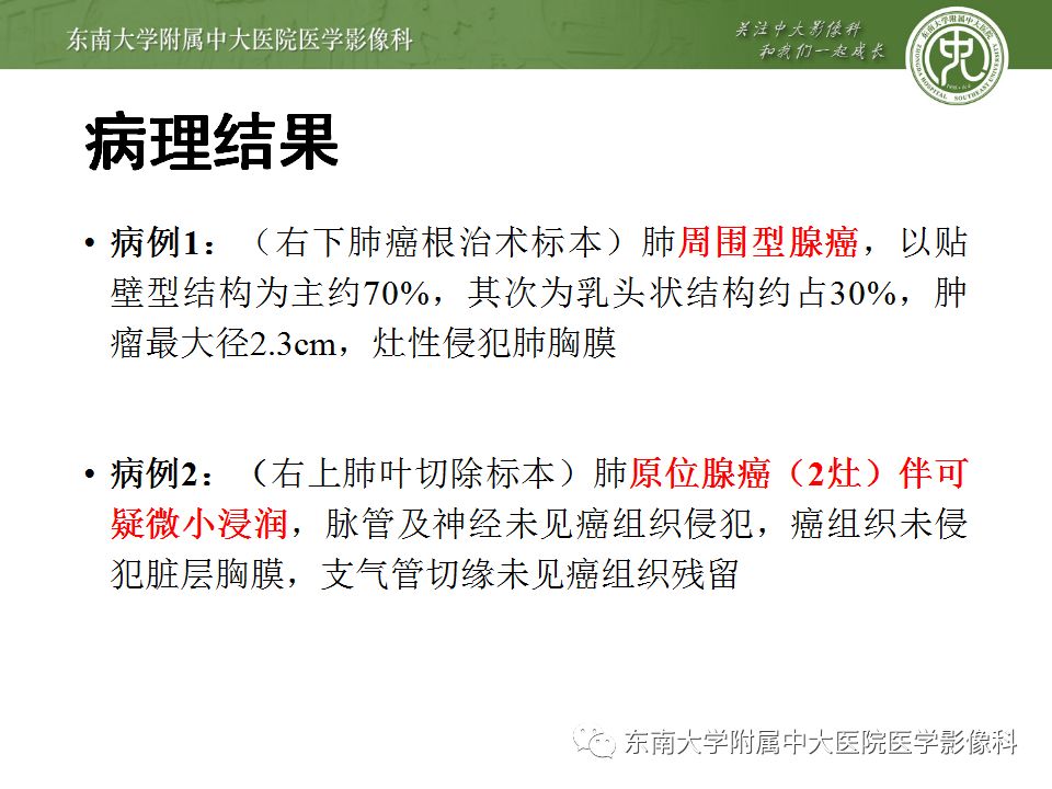 【病例】肺亚实性结节—腺癌两例CT影像表现