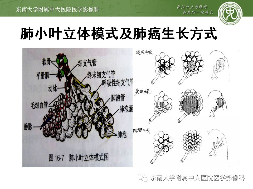 【病例】肺亚实性结节—腺癌两例CT影像表现