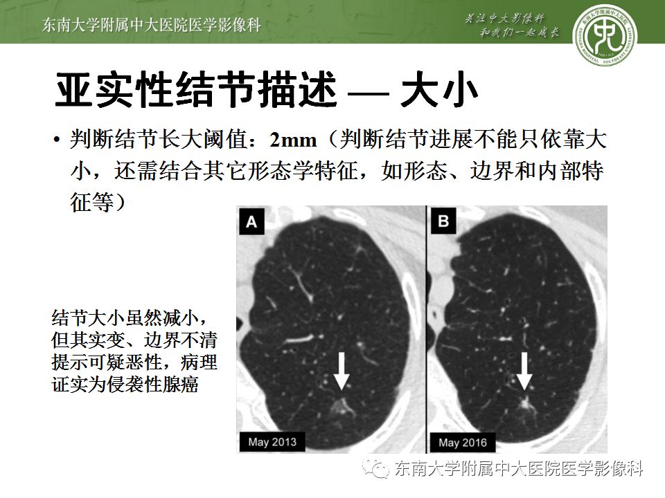 【病例】肺亚实性结节—腺癌两例CT影像表现