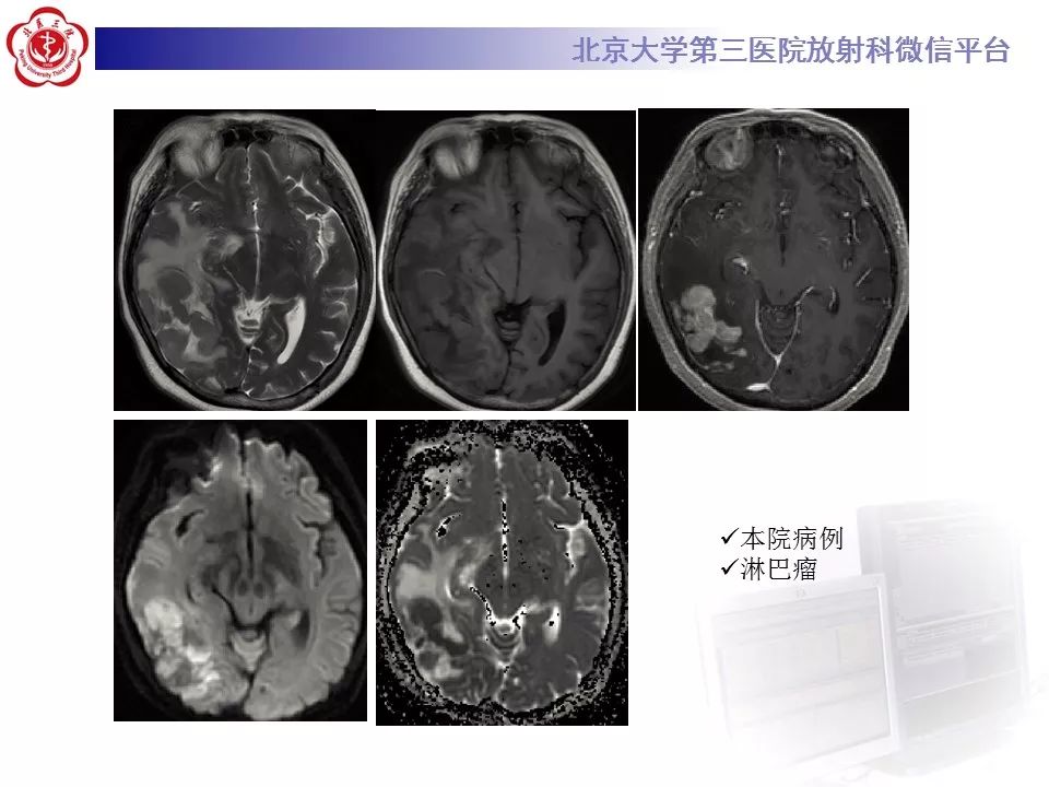 【PPT】弥散加权成像DWI在神经系统的应用