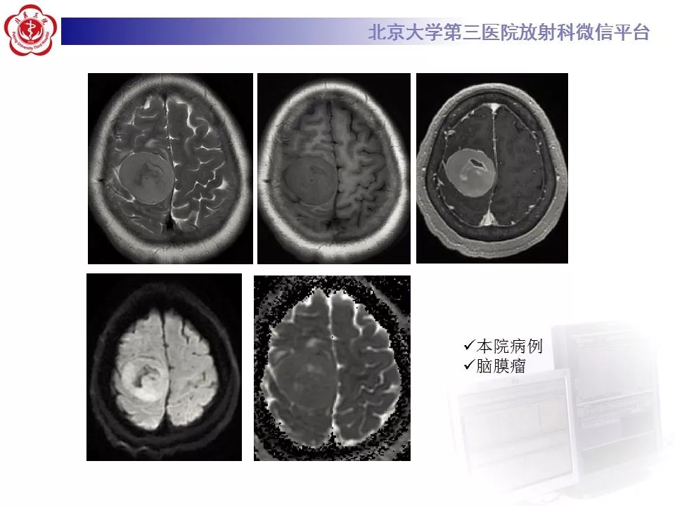 【PPT】弥散加权成像DWI在神经系统的应用