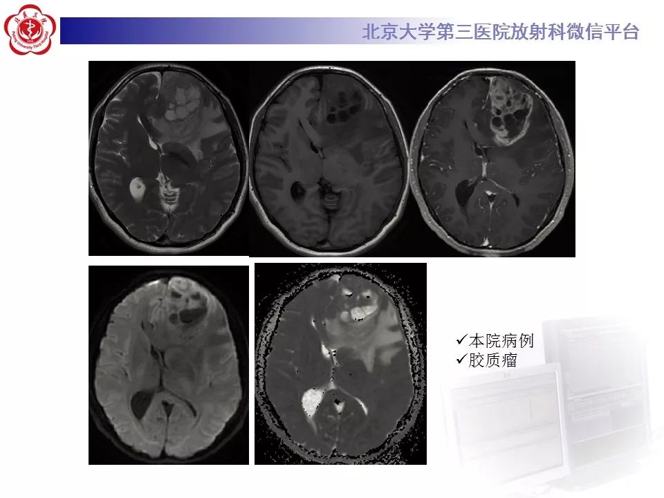 【PPT】弥散加权成像DWI在神经系统的应用