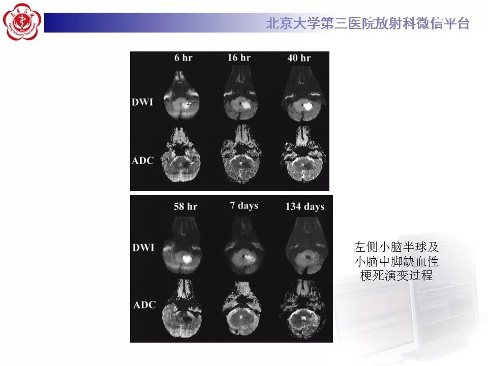 【PPT】弥散加权成像DWI在神经系统的应用