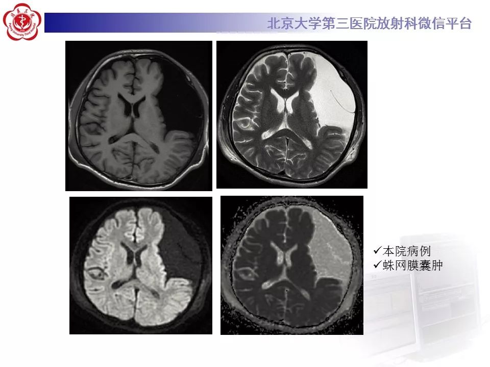 【PPT】弥散加权成像DWI在神经系统的应用