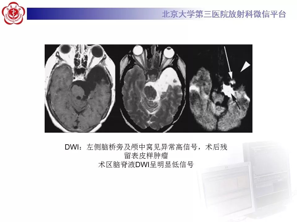 【PPT】弥散加权成像DWI在神经系统的应用