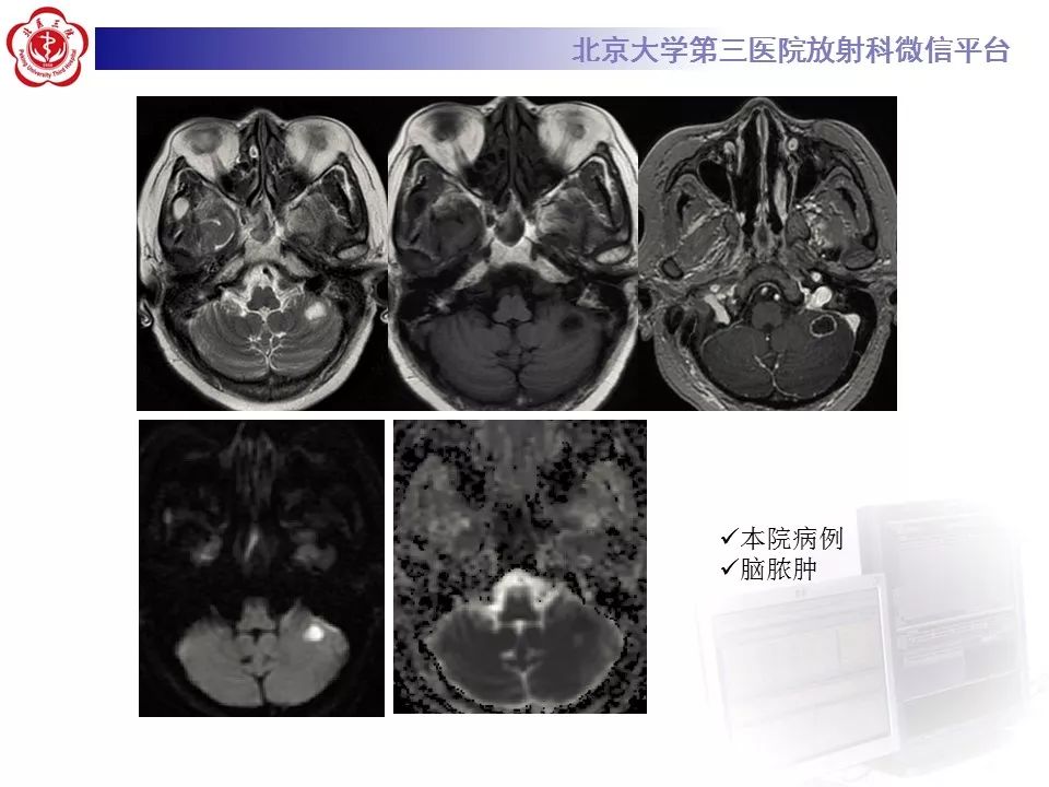 【PPT】弥散加权成像DWI在神经系统的应用