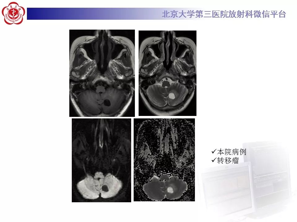 【PPT】弥散加权成像DWI在神经系统的应用