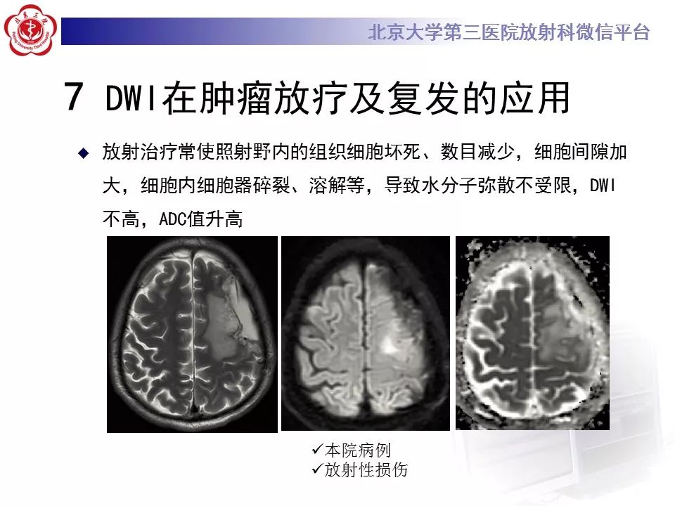 【PPT】弥散加权成像DWI在神经系统的应用