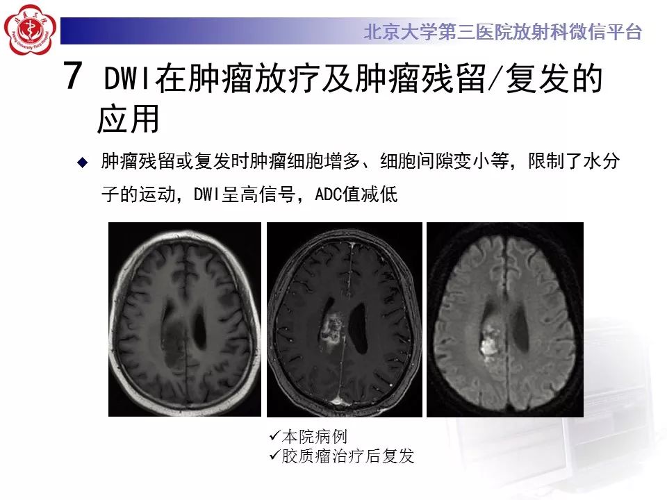 【PPT】弥散加权成像DWI在神经系统的应用