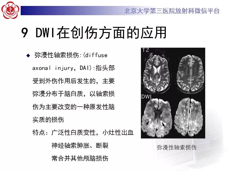 【PPT】弥散加权成像DWI在神经系统的应用