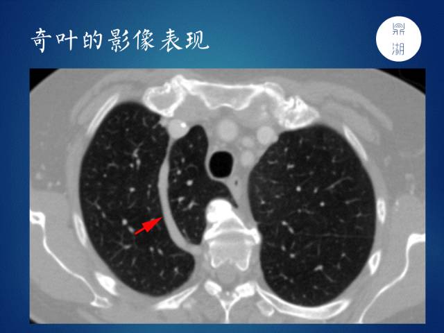【PPT】奇静脉、半奇静脉、副半奇静脉、奇裂、奇叶